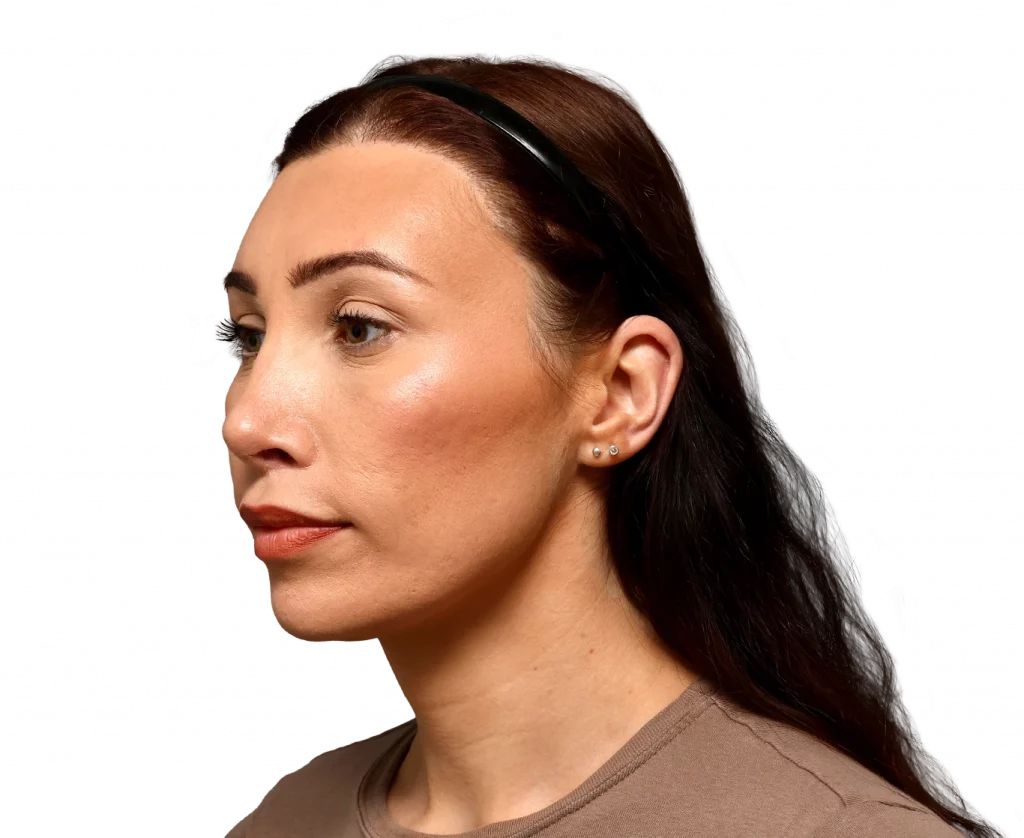 Angled left profile photo of Alexis B. after surgery.