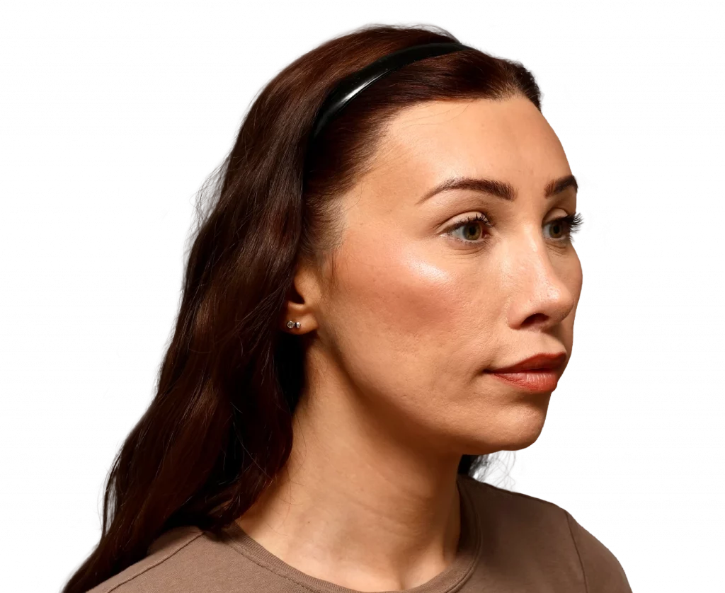 Angled right profile photo of Alexis B. after surgery.