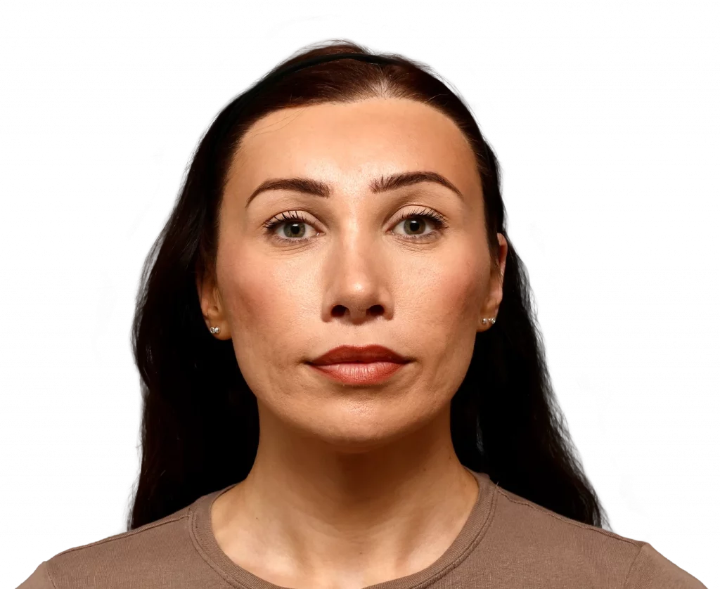 Frontal profile photo of Alexis B. after surgery.