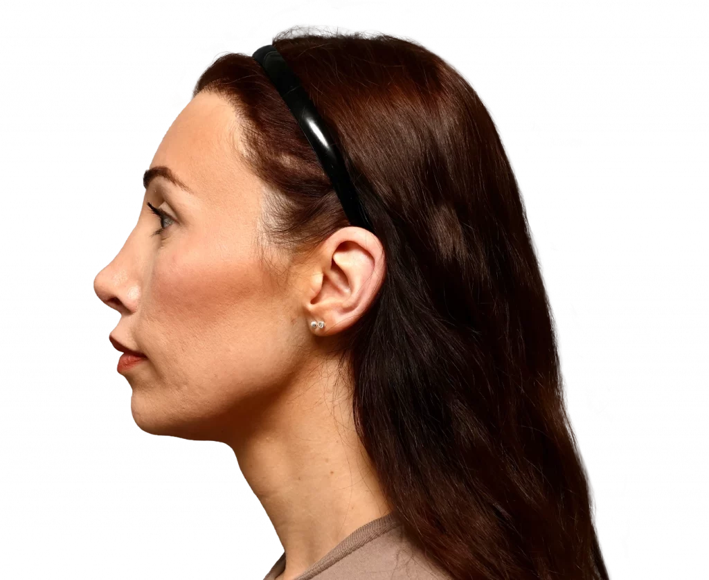 Side left profile photo of Alexis B. after surgery.