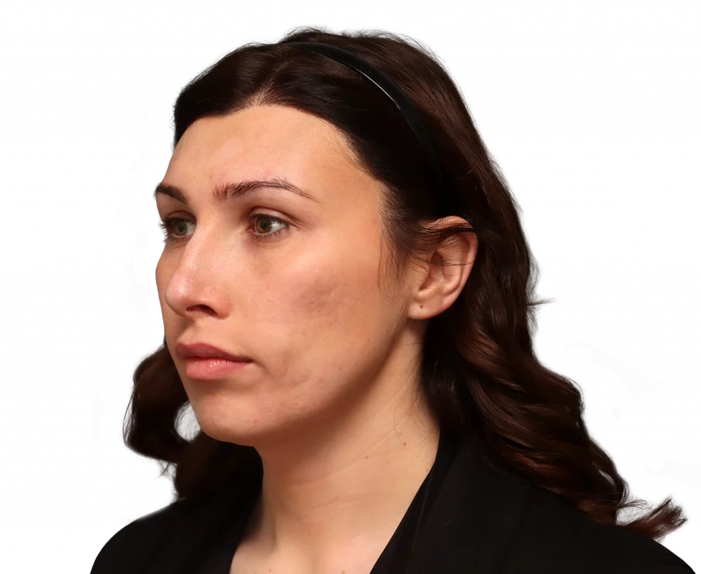 Angled left profile photo of Alexis B. before surgery.
