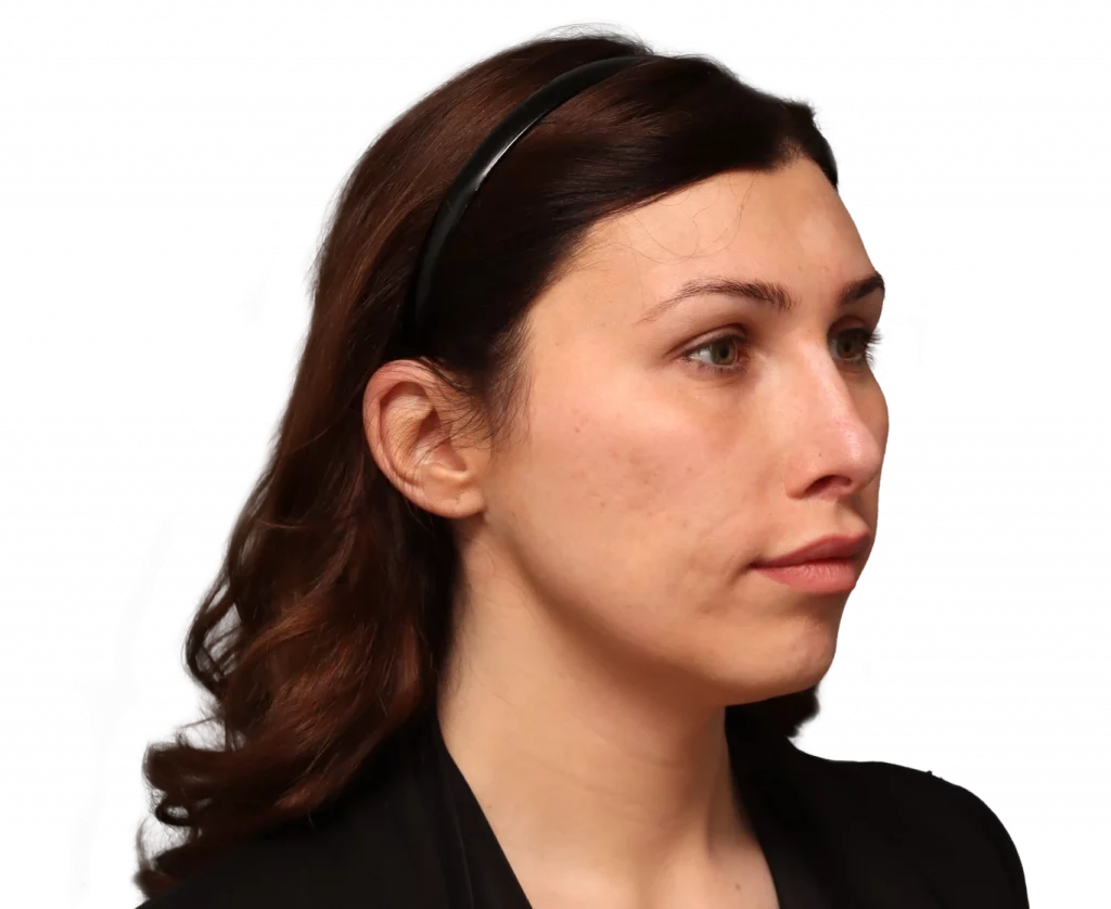 Angled right profile photo of Alexis B. before surgery.