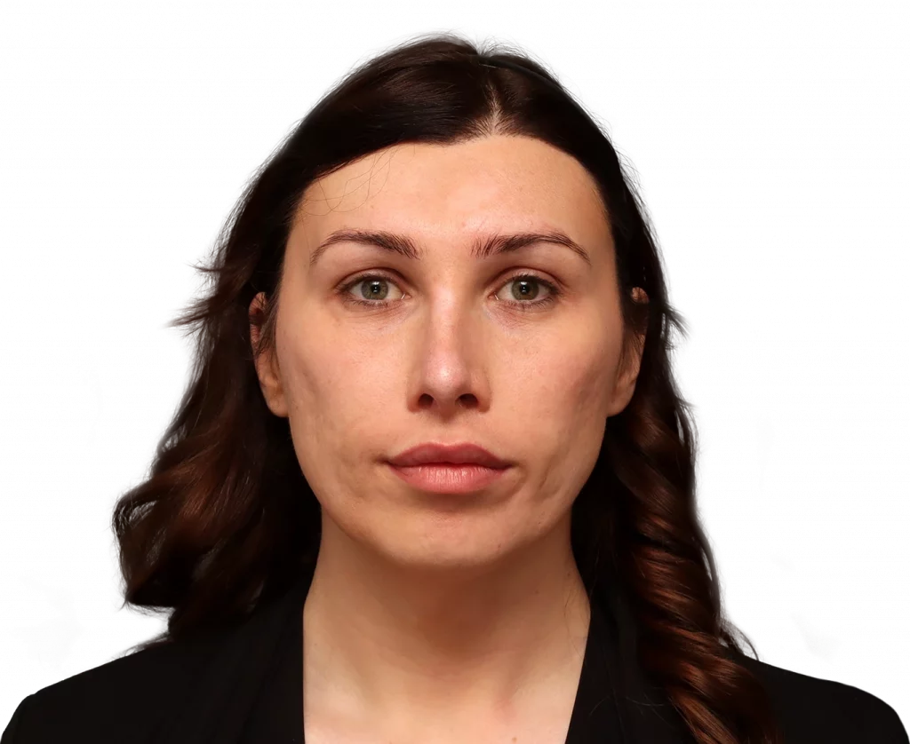 Frontal profile photo of Alexis B. before surgery.