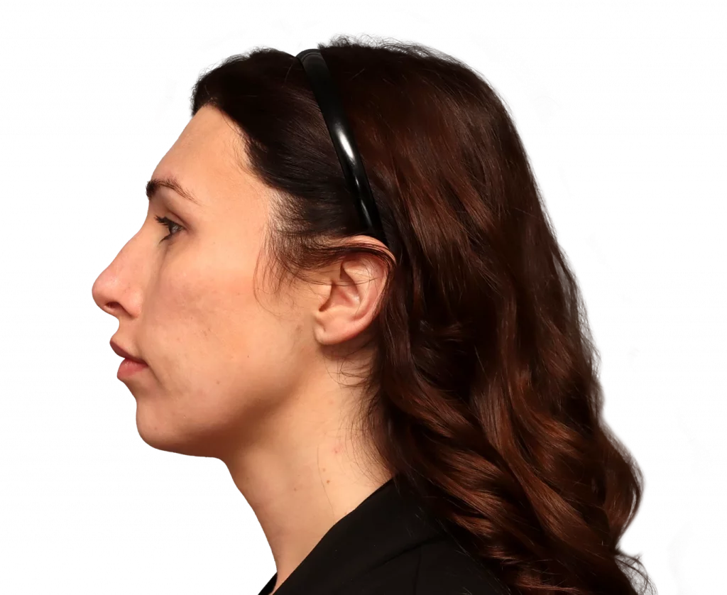 Side left profile photo of Alexis B. before surgery.