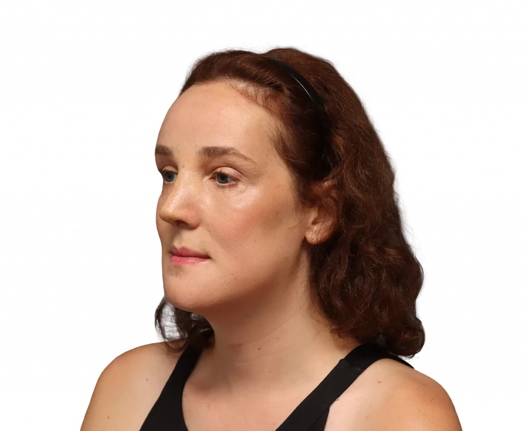 Angled left profile photo of Angelique D. after surgery.