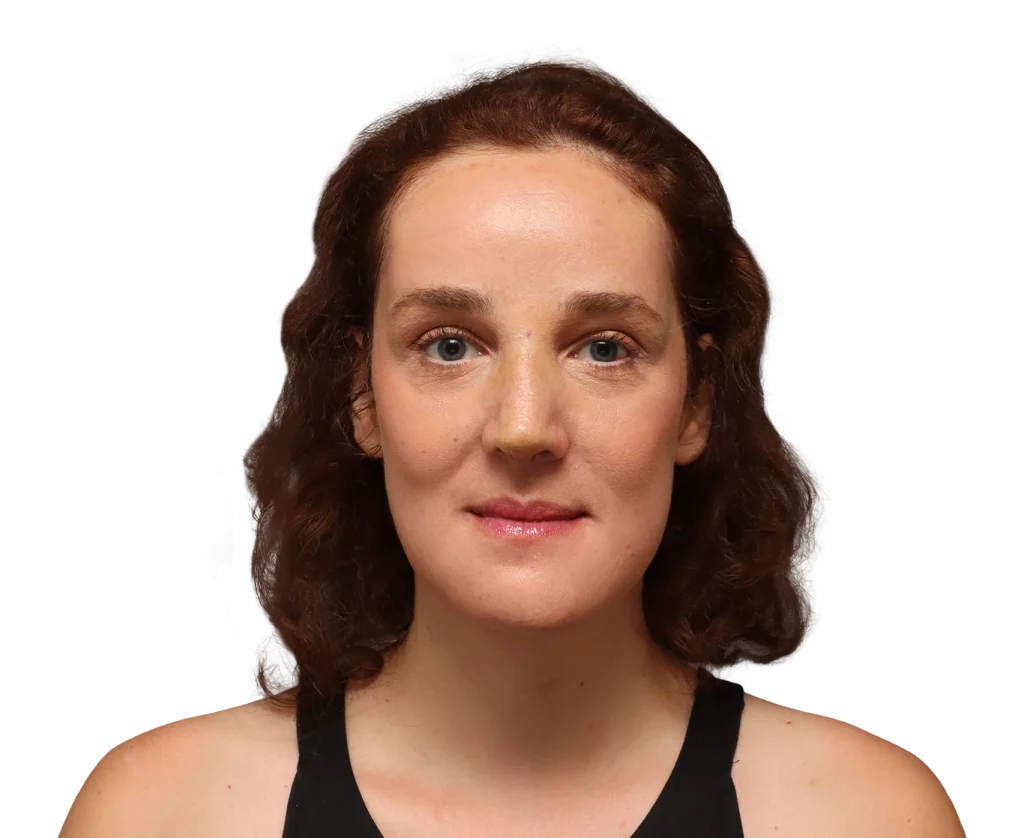 Frontal profile photo of Angelique D. after surgery.
