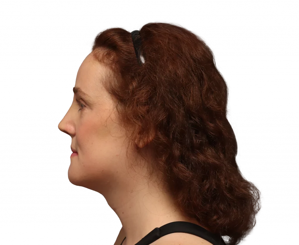 Side left profile photo of Angelique D. after surgery.