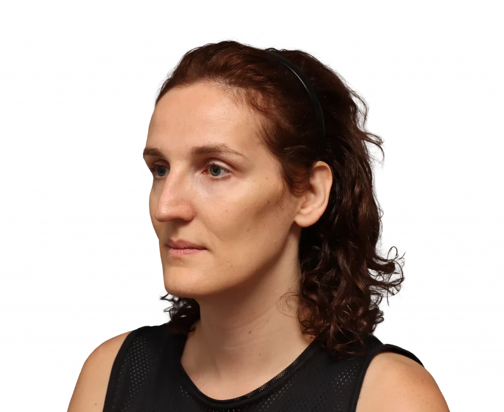 Side left profile photo of Angelique D. before surgery.