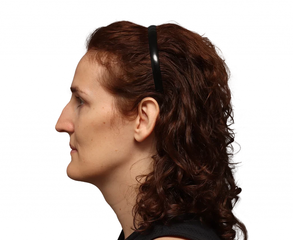 Side left profile photo of Angelique D. before surgery.