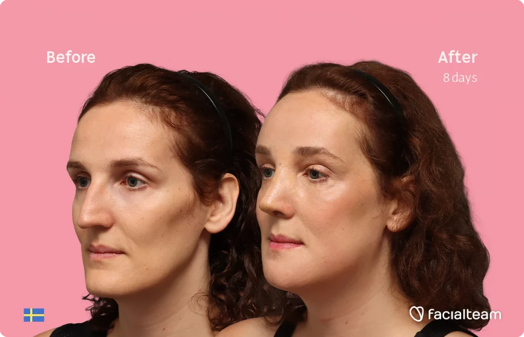 Angled left image of FFS patient Angelique D. showing the results before-after with Facialteam consisting of forehead, jaw, chin, and nose feminization surgery.