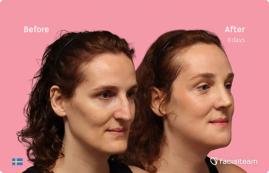 Angled right image of FFS patient Angelique D. showing the results before-after with Facialteam consisting of forehead, jaw, chin, and nose feminization surgery.