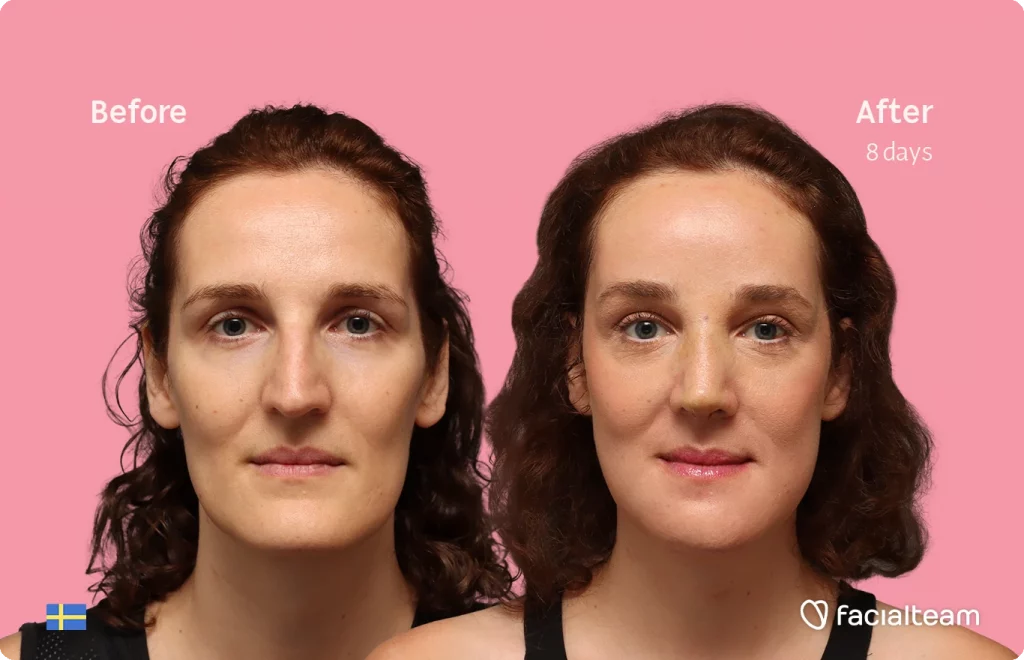 Frontal image of FFS patient Angelique D. showing the results before-after with Facialteam consisting of forehead, jaw, chin, and nose feminization surgery.
