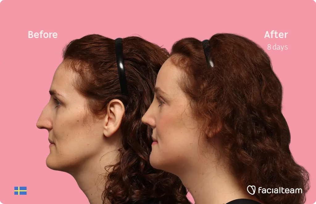 Side left image of FFS patient Angelique D. showing the results before-after with Facialteam consisting of forehead, jaw, chin, and nose feminization surgery.