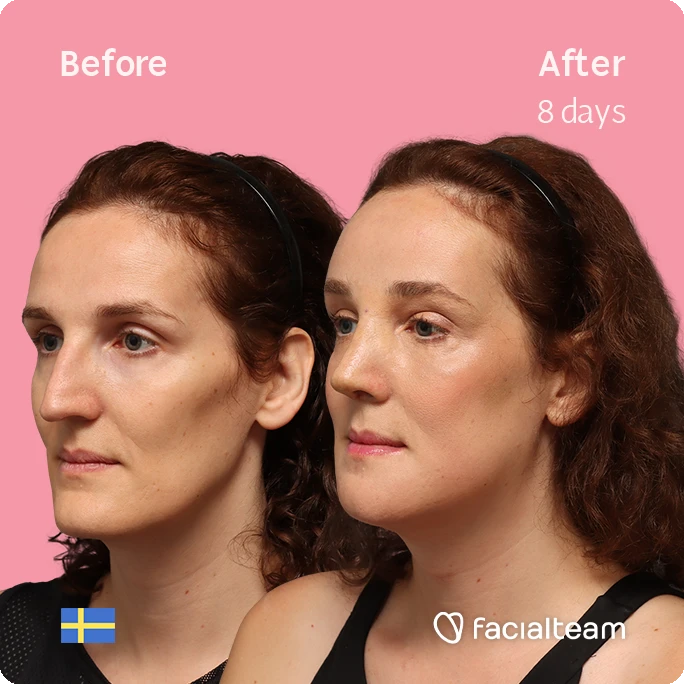 Angled left square image of FFS patient Angelique D. showing the results before-after with Facialteam consisting of forehead, jaw, chin, and nose feminization surgery.