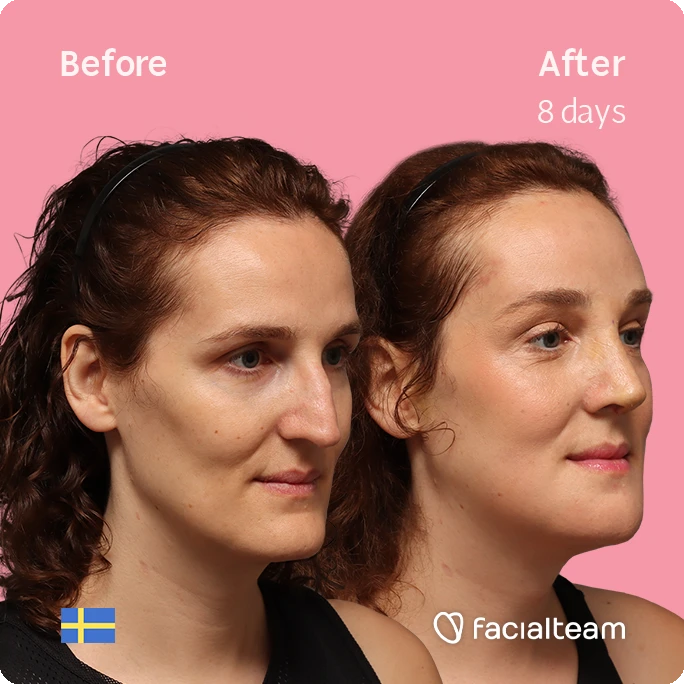 Angled right square image of FFS patient Angelique D. showing the results before-after with Facialteam consisting of forehead, jaw, chin, and nose feminization surgery.