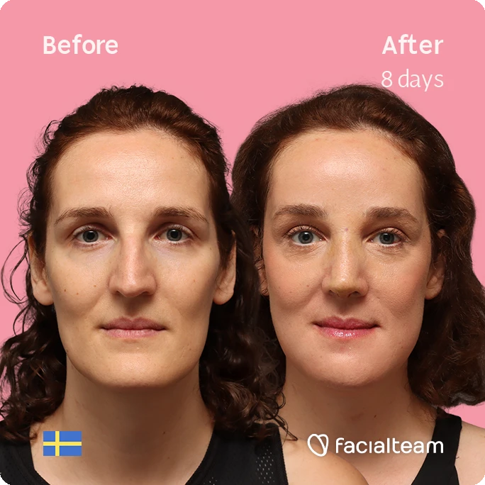 Frontal square image of FFS patient Angelique D. showing the results before-after with Facialteam consisting of forehead, jaw, chin, and nose feminization surgery.