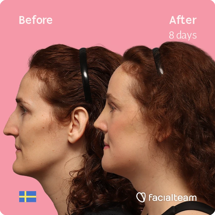 Side left square image of FFS patient Angelique D. showing the results before-after with Facialteam consisting of forehead, jaw, chin, and nose feminization surgery.