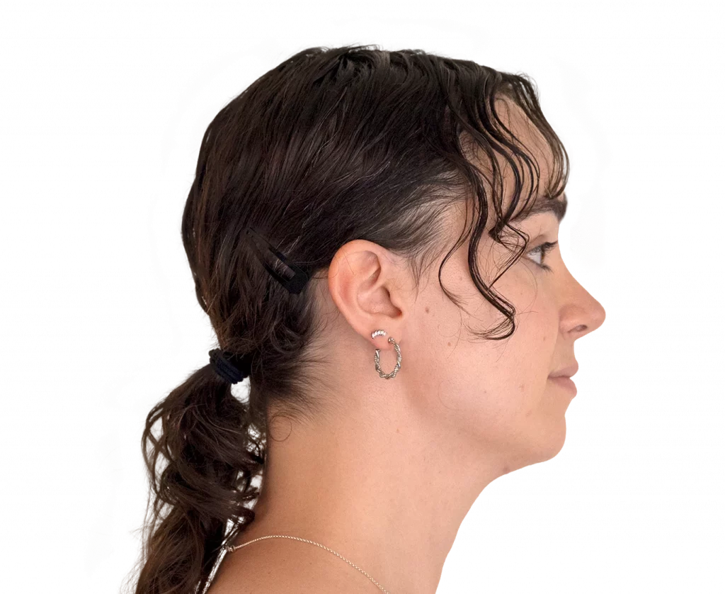 Angled right profile photo of Elle D. after surgery.