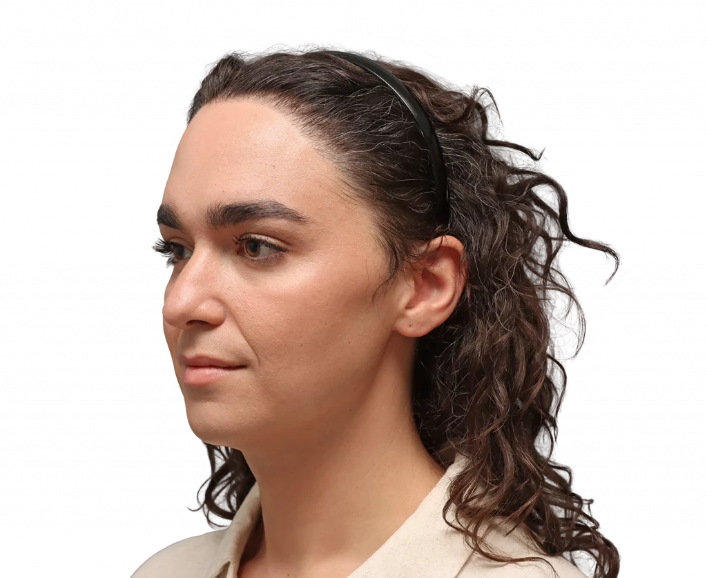 Angled left profile photo of Elle D. before surgery.