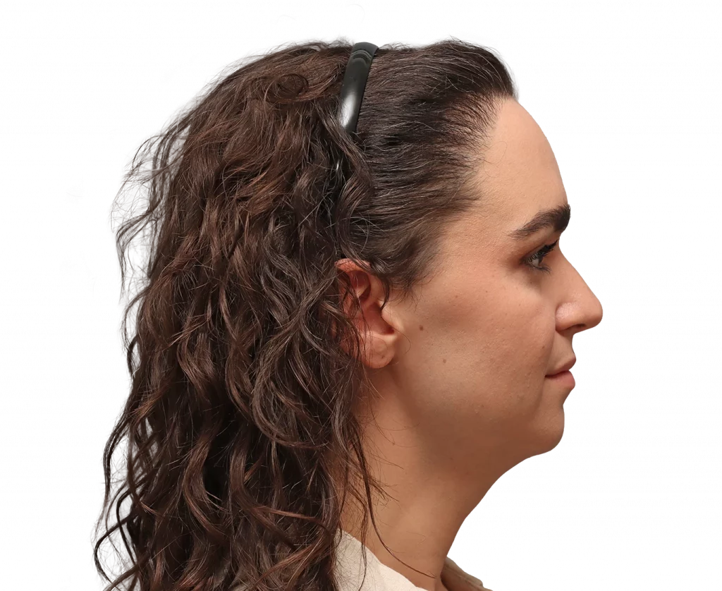 Side right profile photo of Elle D. before surgery.