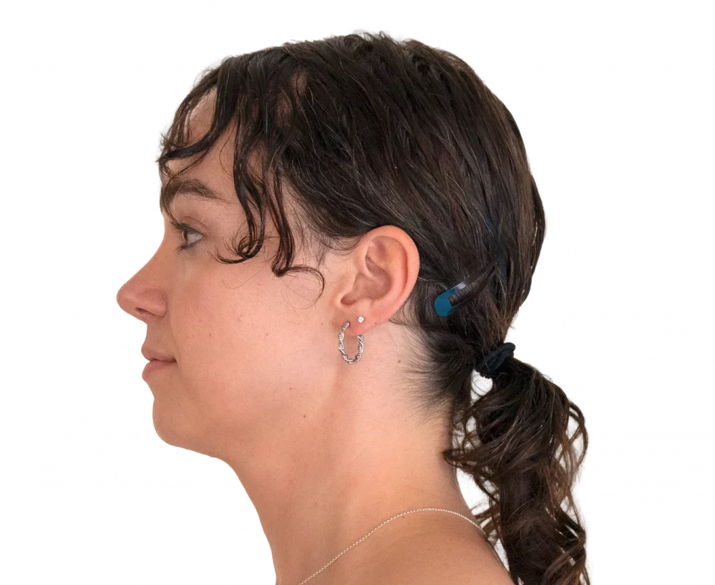 Side left profile photo of Elle D. after surgery.