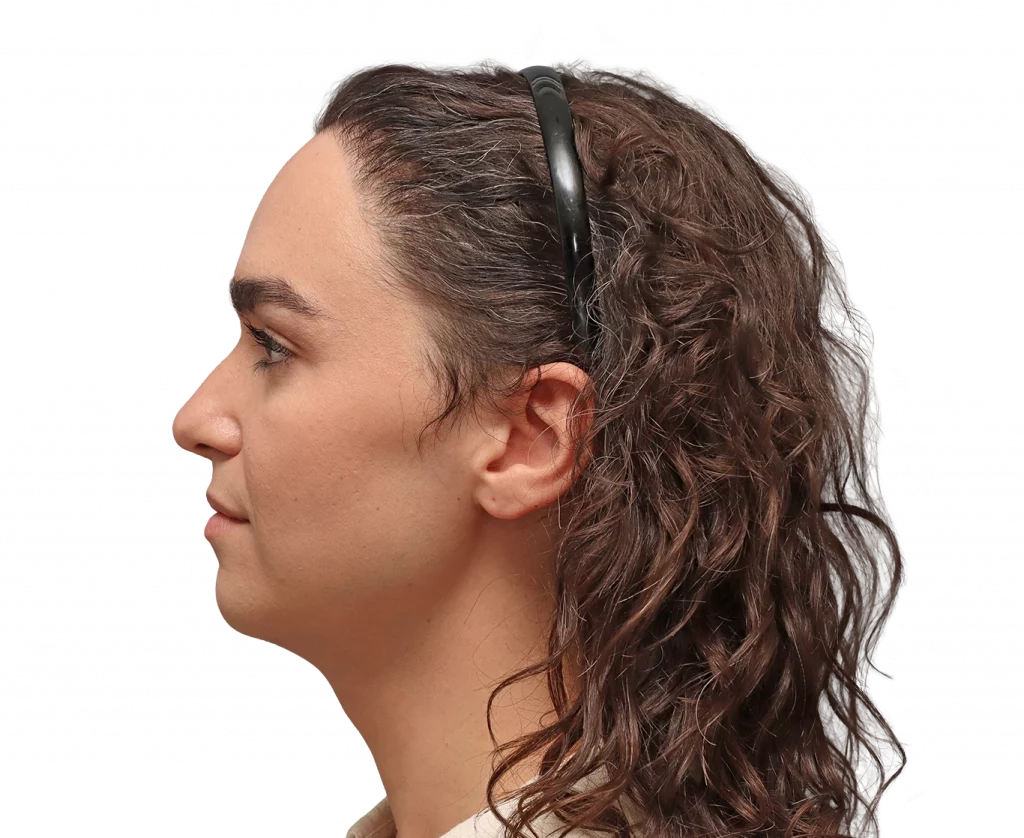 Side left profile photo of Elle D. before surgery.