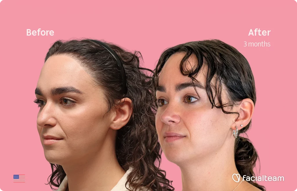 Side left image of FFS patient Elle D. showing the results before-after with Facialteam consisting of forehead, tracheal shave, and nose feminization surgery.