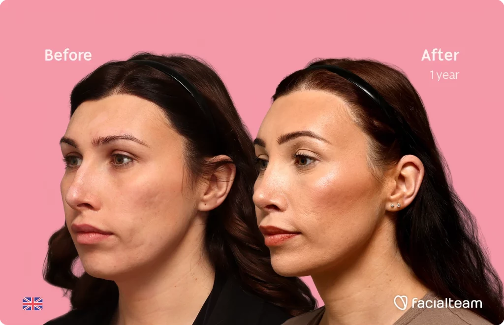 Angled left image of FFS patient Alexis B. showing the results before-after with Facialteam consisting of forehead, tracheal shave, chin and nose feminization surgery.