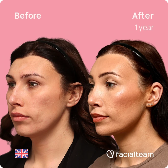 Angled left square image of FFS patient Alexis B. showing the results before-after with Facialteam consisting of forehead, tracheal shave, chin and nose feminization surgery.