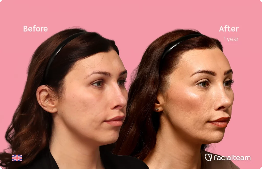 Angled right image of FFS patient Alexis B. showing the results before-after with Facialteam consisting of forehead, tracheal shave, chin and nose feminization surgery.