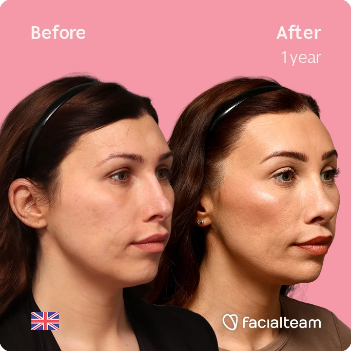 Angled right square image of FFS patient Alexis B. showing the results before-after with Facialteam consisting of forehead, tracheal shave, chin and nose feminization surgery.