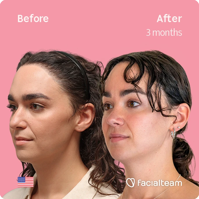 Angled left square image of FFS patient Elle D. showing the results before-after with Facialteam consisting of forehead, tracheal shave, and nose feminization surgery.