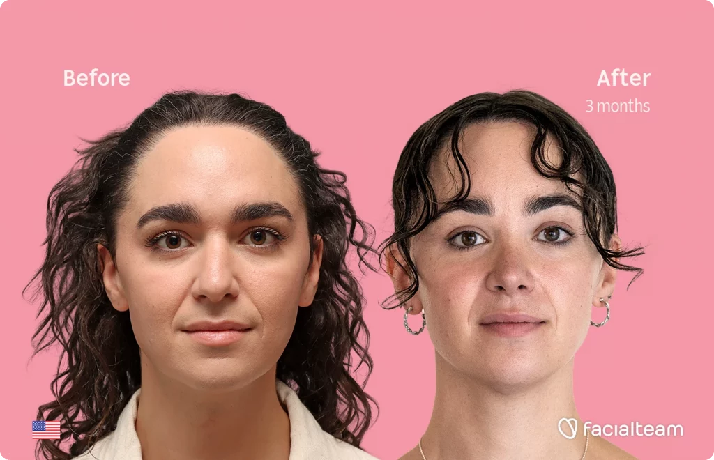 Frontal image of FFS patient Elle D. showing the results before-after with Facialteam consisting of forehead, tracheal shave, and nose feminization surgery.