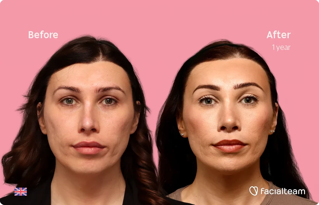 Frontal image of FFS patient Alexis B. showing the results before-after with Facialteam consisting of forehead, tracheal shave, chin and nose feminization surgery.