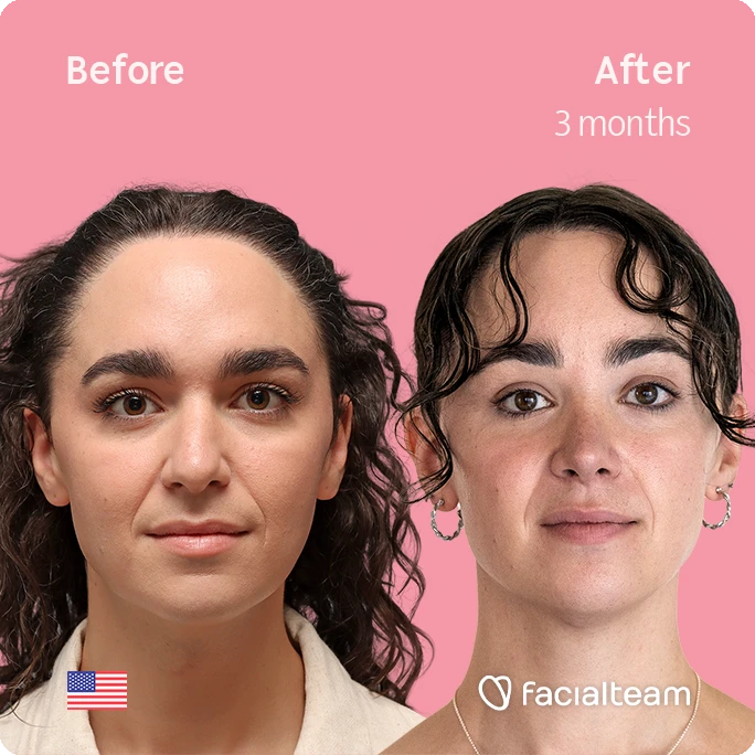 Frontal square image of FFS patient Elle D. showing the results before-after with Facialteam consisting of forehead, tracheal shave, and nose feminization surgery.