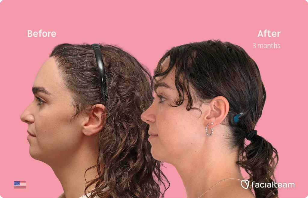 Side left image of FFS patient Elle D. showing the results before-after with Facialteam consisting of forehead, tracheal shave, and nose feminization surgery.
