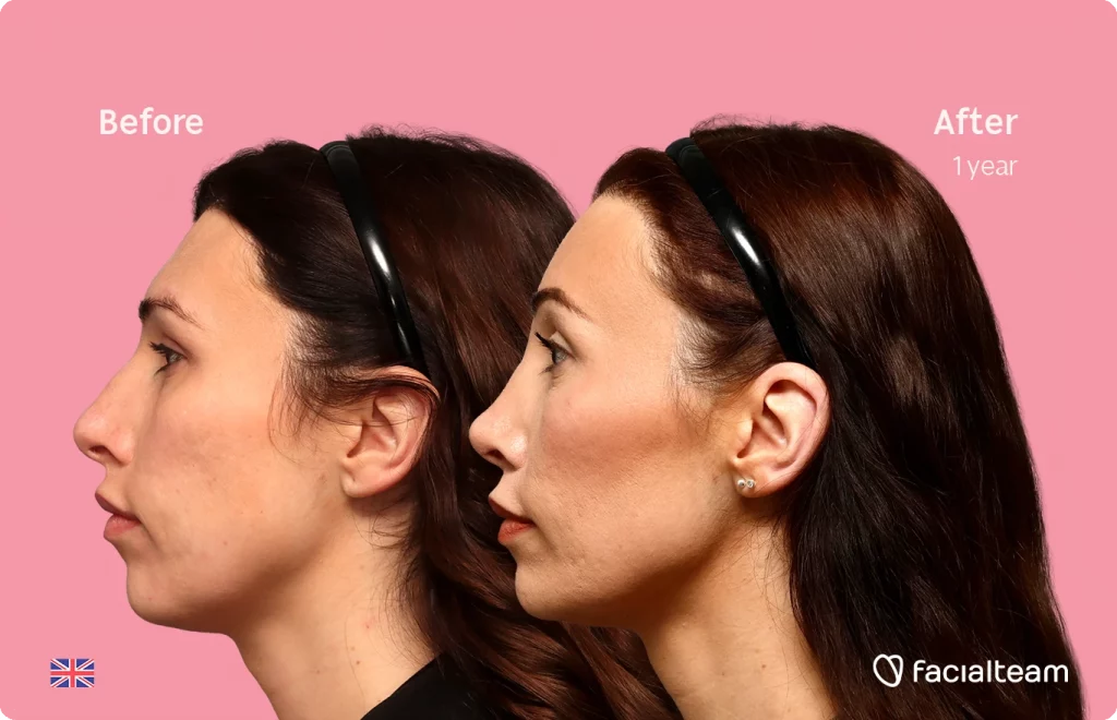 Side left image of FFS patient Alexis B. showing the results before-after with Facialteam consisting of forehead, tracheal shave, chin and nose feminization surgery.