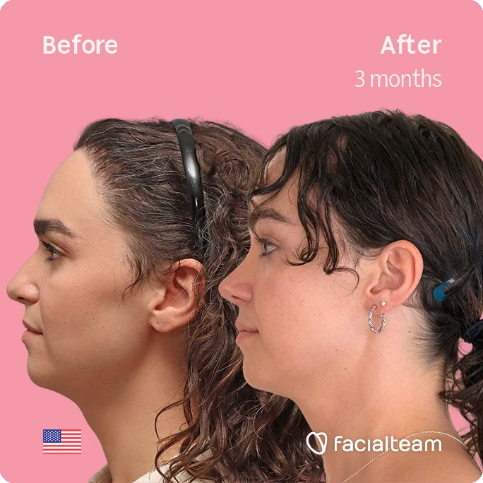 Side left square image of FFS patient Elle D. showing the results before-after with Facialteam consisting of forehead, tracheal shave, and nose feminization surgery.