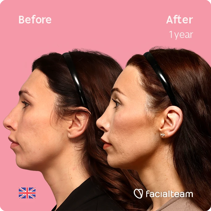 Side left square image of FFS patient Alexis B. showing the results before-after with Facialteam consisting of forehead, tracheal shave, chin and nose feminization surgery.