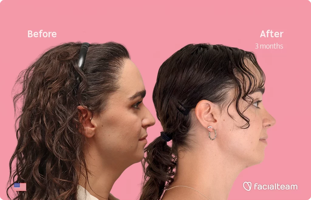 Side right image of FFS patient Elle D. showing the results before-after with Facialteam consisting of forehead, tracheal shave, and nose feminization surgery.