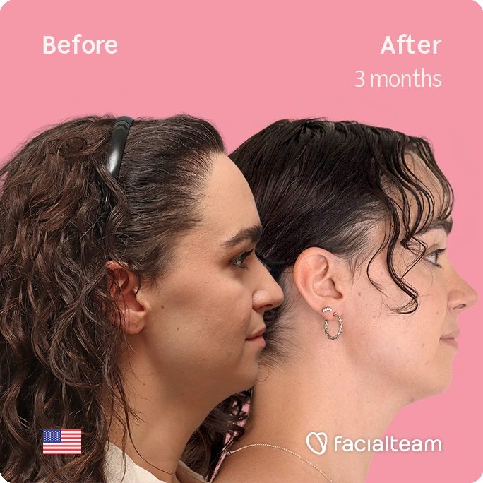 Side right square image of FFS patient Elle D. showing the results before-after with Facialteam consisting of forehead, tracheal shave, and nose feminization surgery.