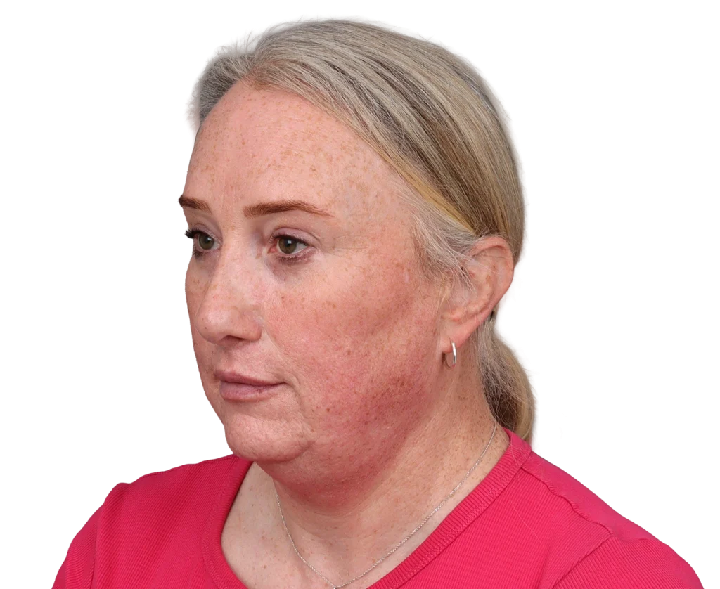 Profile view of a middle-aged woman with freckles and red cheeks, wearing a pink top and small hoop earring