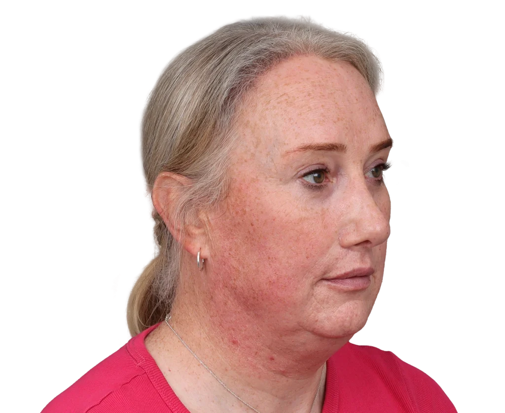 Profile view of a middle-aged woman with fair skin showing facial redness and freckles, wearing a pink shirt and a silver necklace; looking to the right.