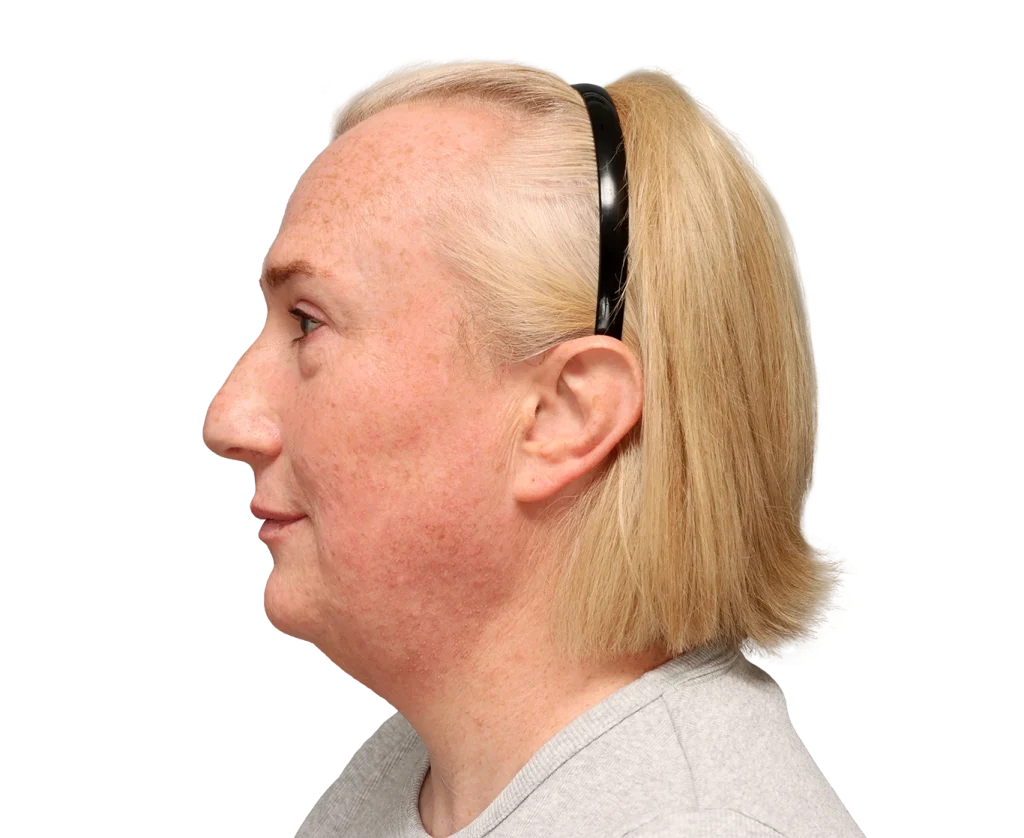 Profile view of a blonde woman wearing a black headband, showing freckles and sun-damaged skin on her face.