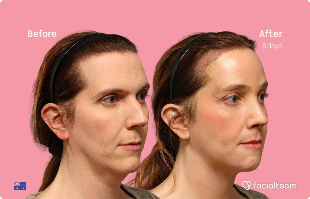 Before-and-after photo of a woman's face showing 8 days of treatment; pink background, 'facialteam' logo in corner.