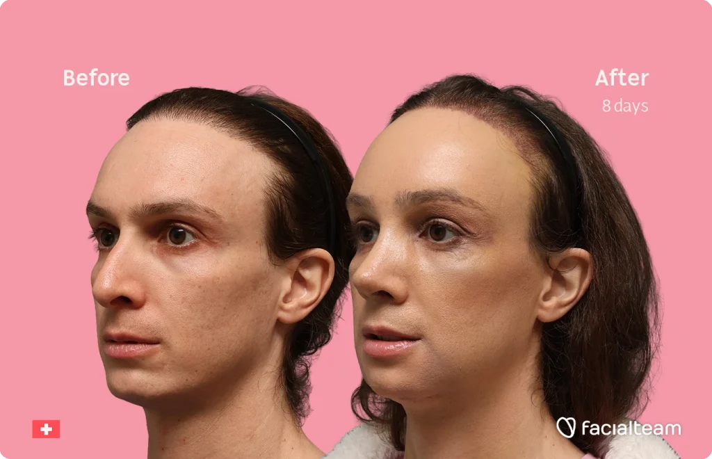 Side-by-side portraits of a woman before and after 8 days of treatment, pink background with 'Before' on the left and 'After 8 days' on the right.