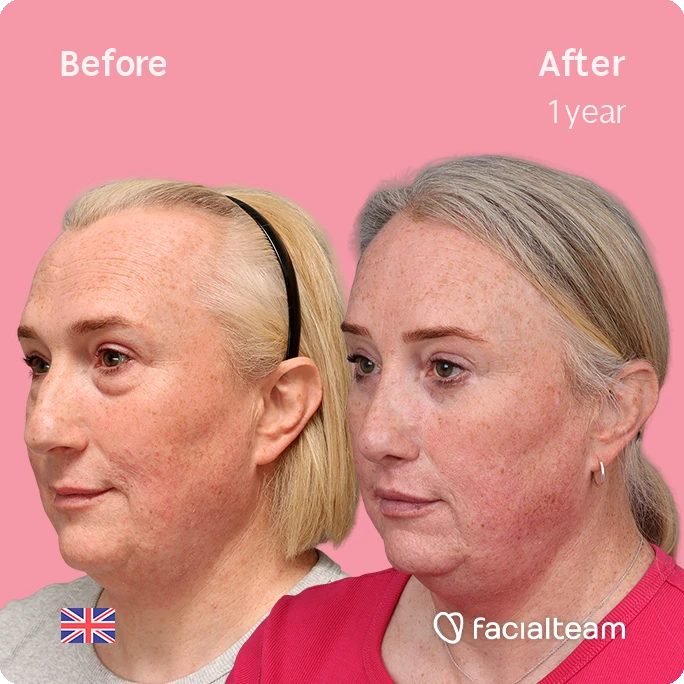 Side-by-side before (left) and after (right) photos of a woman's face showing reduced redness and smoother skin after one year of treatment; pink background.