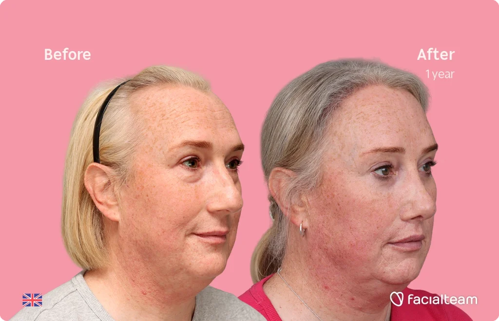 Side-by-side before and after photos showing a woman’s improved skin after one year of treatment (redness reduced, complexion clearer).