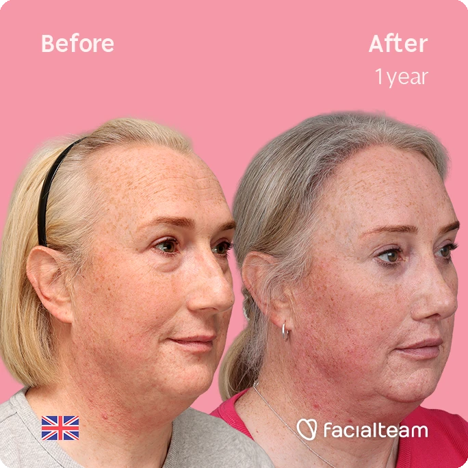 Before and after side-by-side portraits of a woman after facial treatment, pink background, one-year result; visible facial tightening and smoother skin; UK flag watermark.