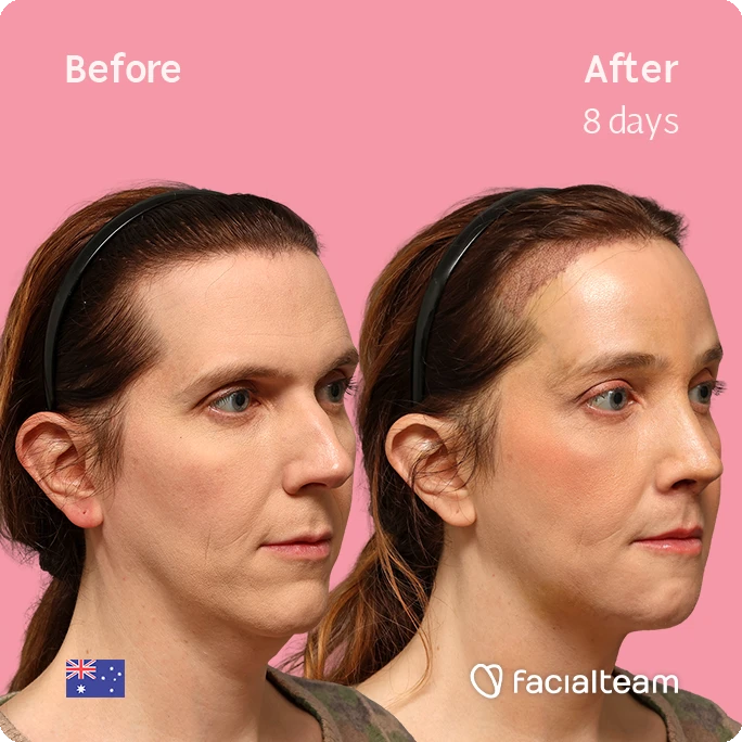 Side-by-side photos of a woman before (left) and after 8 days of treatment, showing smoother jawline and fuller cheeks against a pink background with facialteam branding.